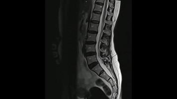 magnetische resonantiebeelden van lumbale wervelkolom sagittale t2-gewogen beelden, mri-lumbale wervelkolom, die een milde schijfziekte laten zien. foto