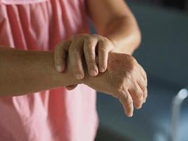 vrouw hand in hand zeldzame aandoening lichaam immuunsysteem valt zenuwen aan, guillan barre-syndroom, vaccin covid-19 coronavirus behandeling foto