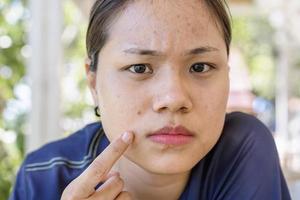 jonge aziatische vrouw maakt zich zorgen over haar gezicht als ze problemen heeft met de huid op haar gezicht op een natuurlijke achtergrond. problemen met acne en littekens op de vrouwelijke huid. probleem huidverzorging en gezondheidsconcept. foto