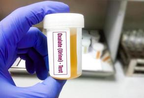 urine-oxalaattests om secundaire of primaire hyperoxalurie, idiopathische hyperoxalurie of overmatige inname van oxalaat of vitamine C in de voeding te diagnosticeren. foto