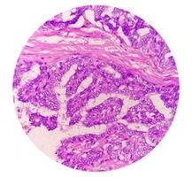schildklierkanker, microscopisch beeld van gemetastaseerd papillair carcinoom van schildklier, centrale lymfeklier. foto