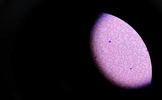 microfoto of microscopische afbeelding die hemoglobine d-eigenschap toont met bloedarmoede door ijzertekort. foto