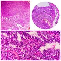 fotocollage van microscopisch beeld van papillair schildkliercarcinoom. foto