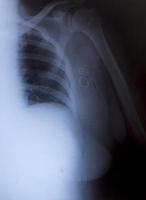 röntgenfoto van de menselijke borst voor een medische diagnose foto