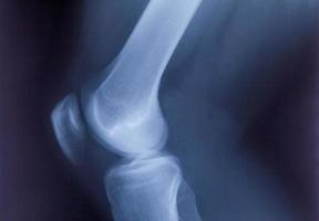 enkelvoeten en kniegewrichtspijn röntgenfoto mri-fotofilm