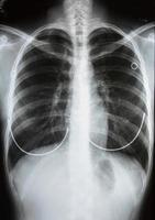 röntgenfoto van de menselijke borst