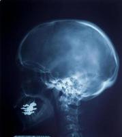 x ray mri van nek- en hoofdspanning van de wervelkolom foto