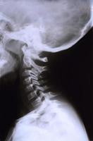 röntgenstraal foto