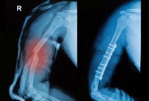 röntgenfoto van borkenarmbeen toont pre-post operatie