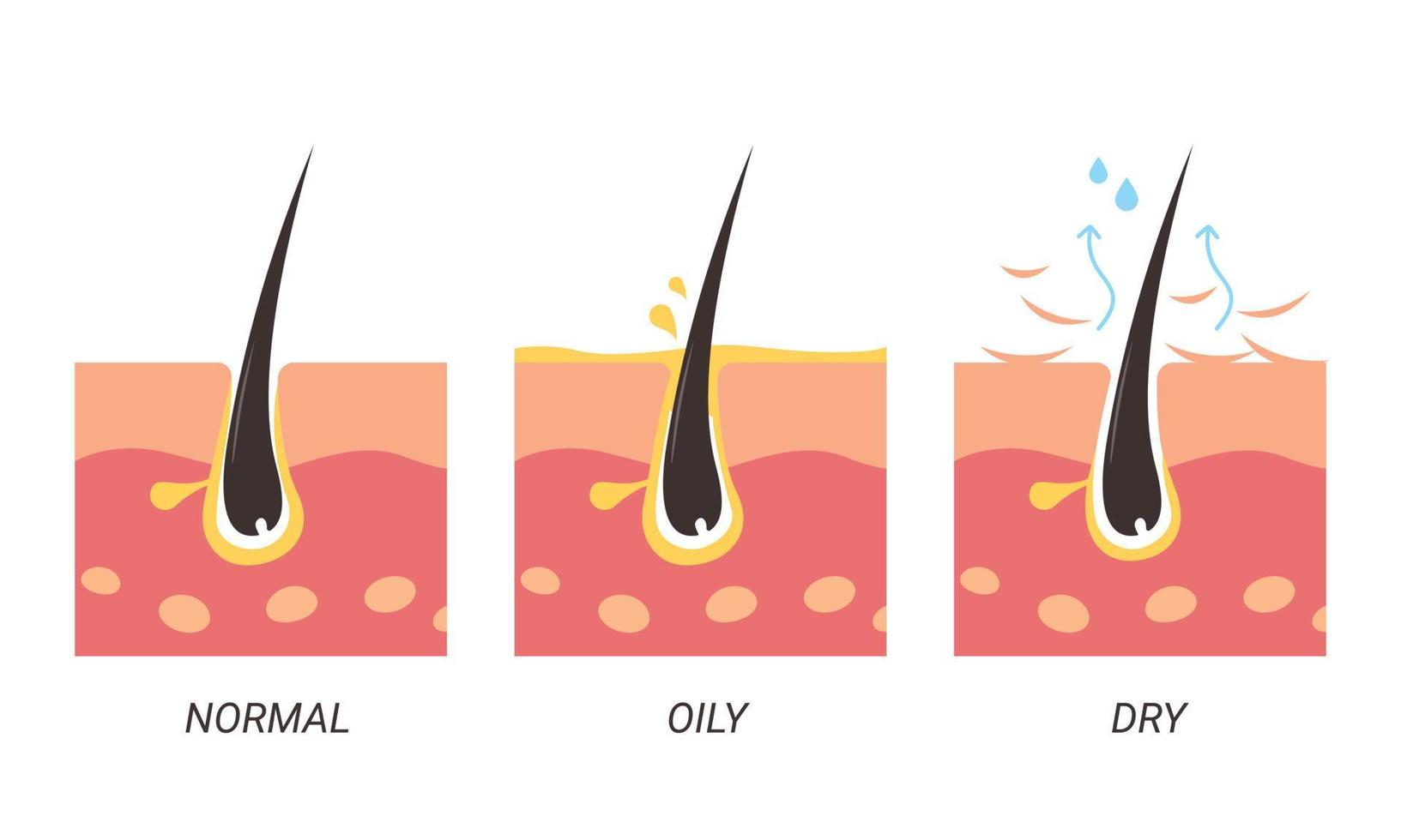 illustratie normale, vette en droge poriën vector