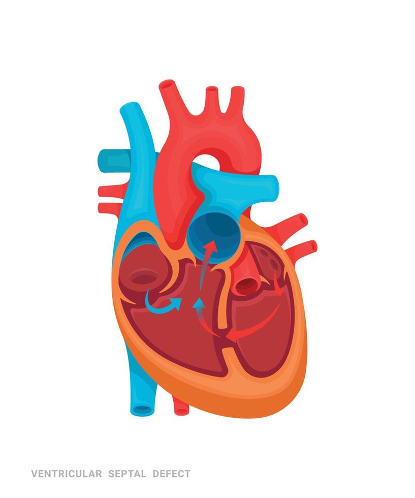 hart van defect vector