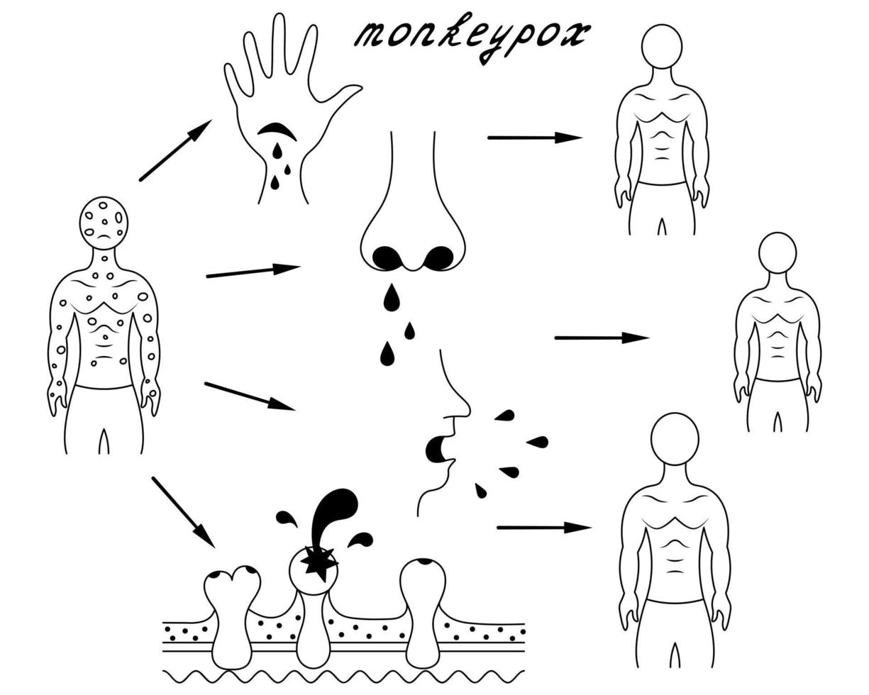 methoden van menselijk infectie met apenpokken. diagram van van mens tot mens transmissie van pokken. schetsen. in contact met lichaam vloeistoffen, beschadigd huid, afscheidingen van puistjes. vector illustratie.
