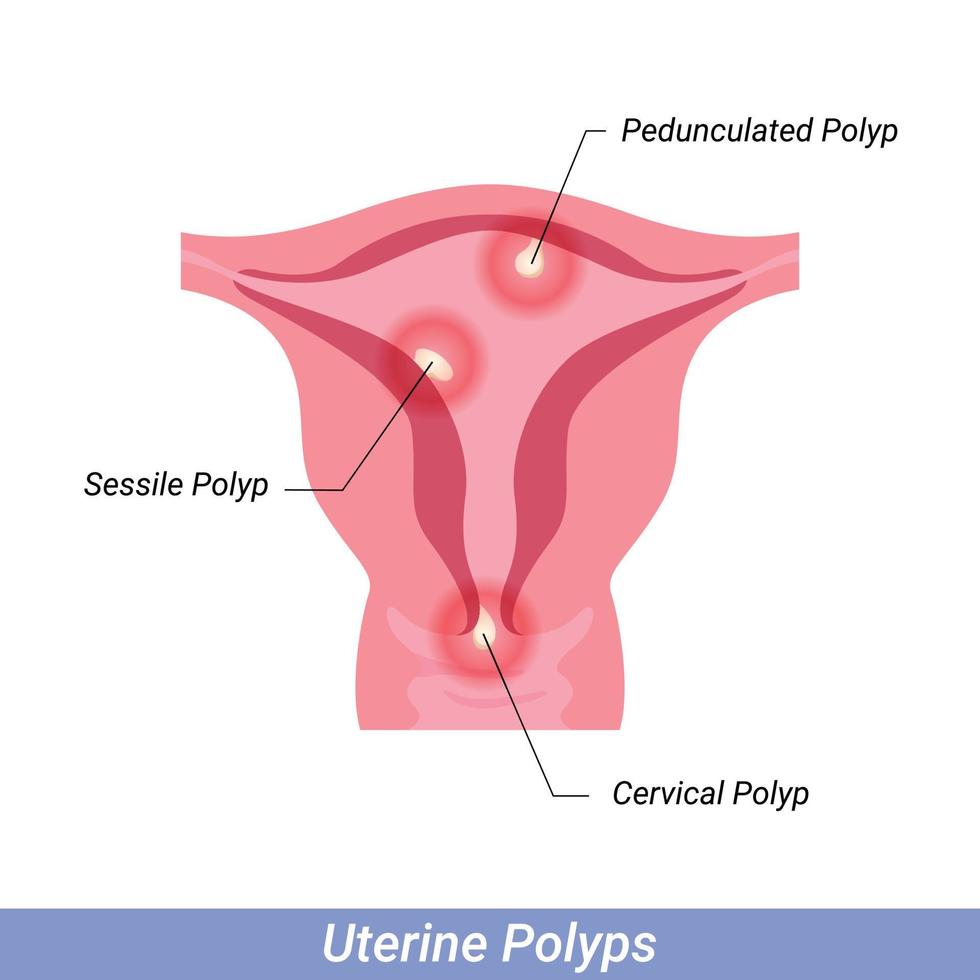 poliepen in de baarmoeder vrouw voortplantings- systeem. menselijk anatomie intern organen vector