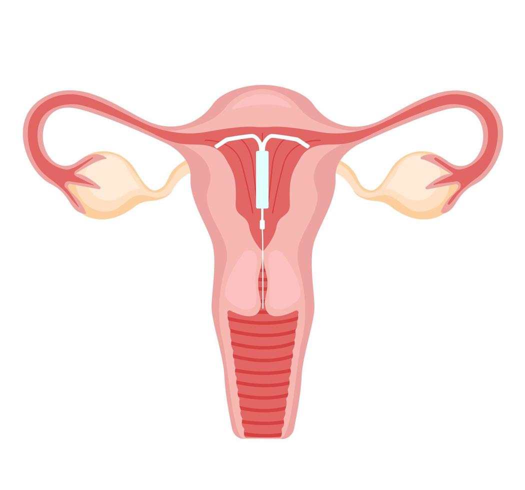 de methode van iud-anticonceptie. controle en bescherming van zwangerschap. intra-uterien apparaat in de baarmoeder. vector illustratie in een vlak stijl.