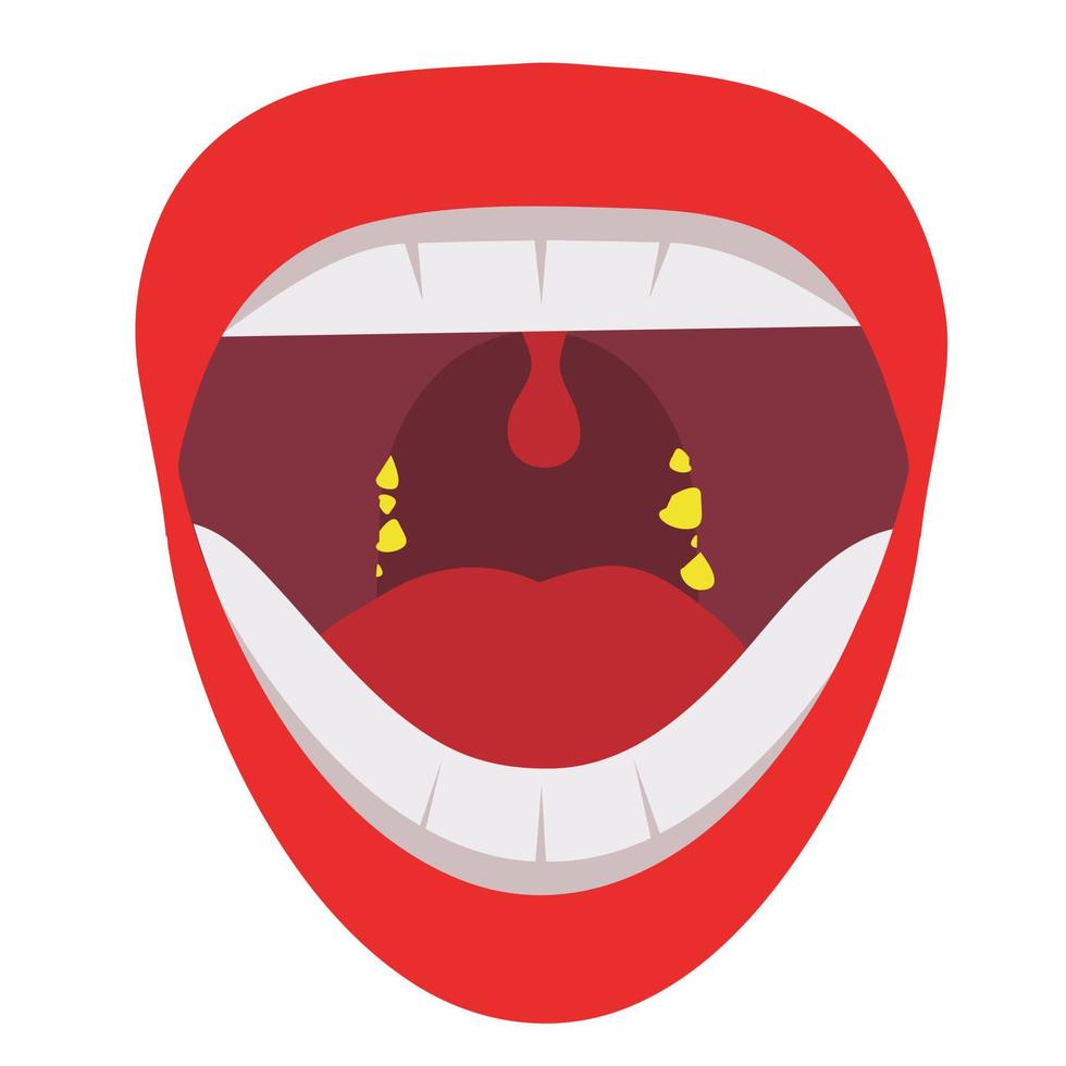 amandel steen in de mond vector. menselijk mond probleem vector illustratie.