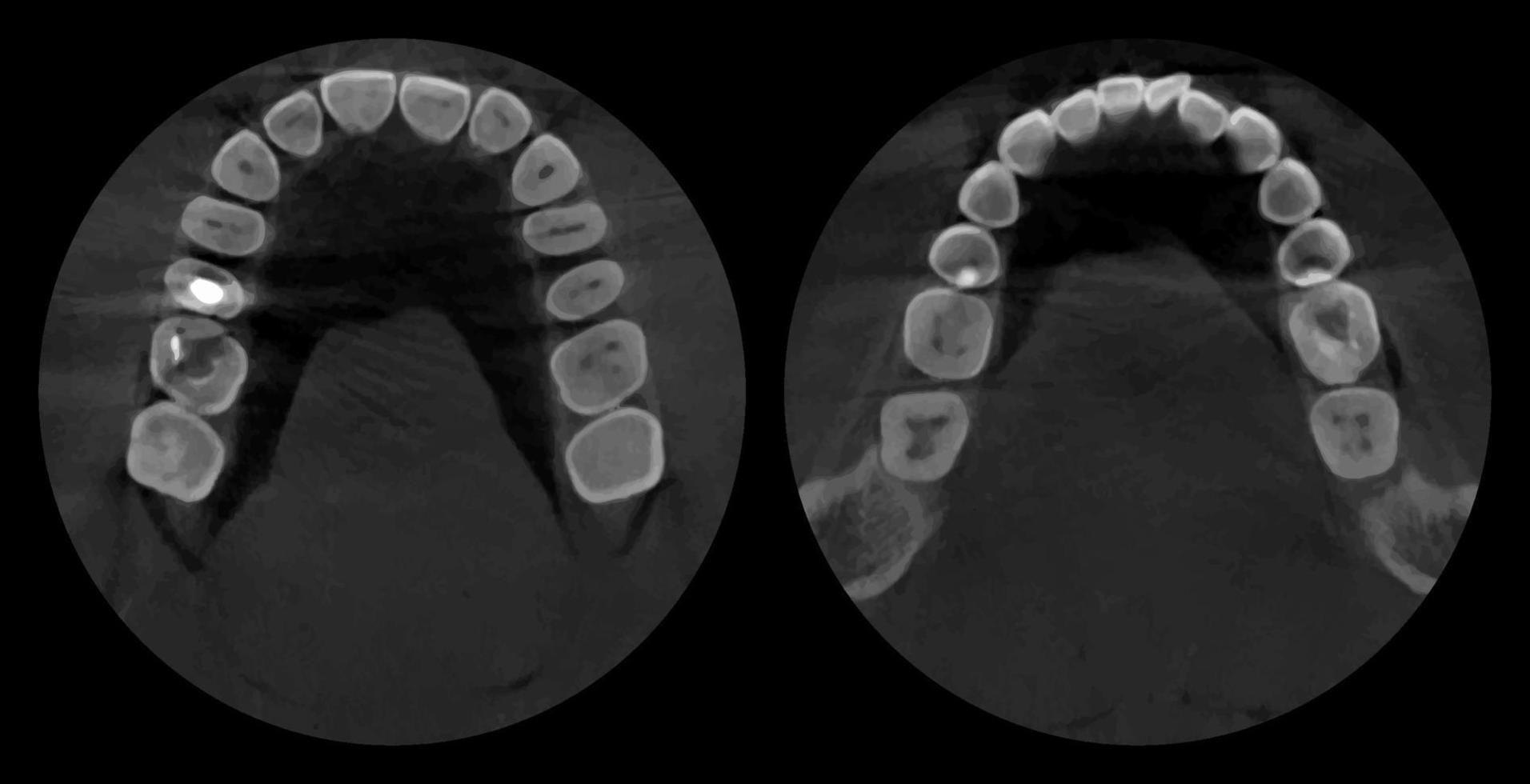 tanden, realistisch 3d scannen kaak, tandheelkundig mri met cariës, scanner afbeelding. tandheelkundig röntgenstraal examen grafisch, nieuw technologieën in tandheelkunde. vector illustratie.