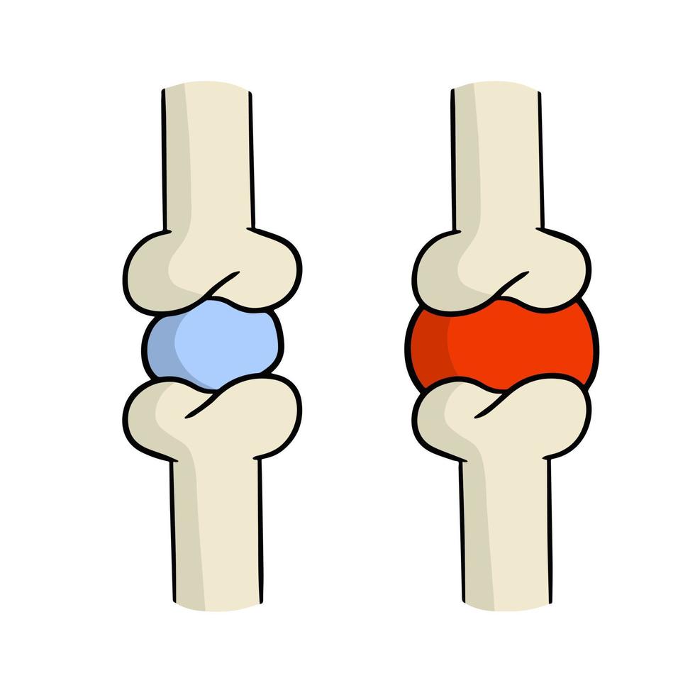 artritis. ziekte van gewrichten. botten en interosseus kraakbeen. biologie en anatomie. medisch onderwijs en chirurgie. rood zeer plek. tekenfilm illustratie vector