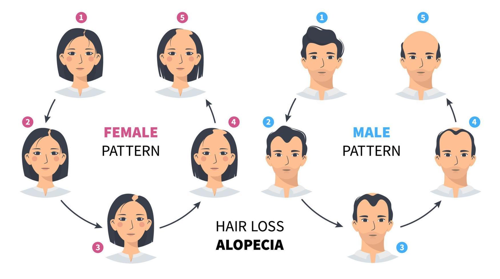 haar- verlies stadia, androgenetisch alopecia mannetje en vrouw patroon. stappen van kaalheid vector cirkel infographic in een vlak stijl met een Mens en een vrouw. veranderen de haarlijn Aan de hoofdhuid