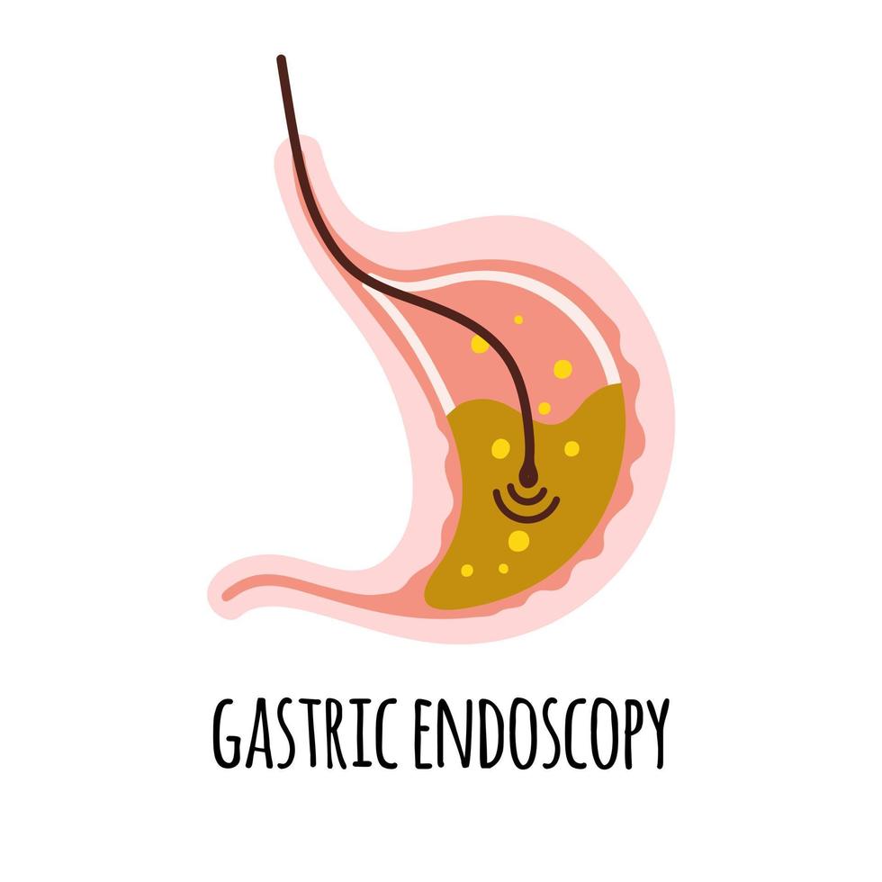 endoscopie. de maag van een persoon met hoog zuurgraad. gastro-enterologie. vector illustratie in een vlak stijl.