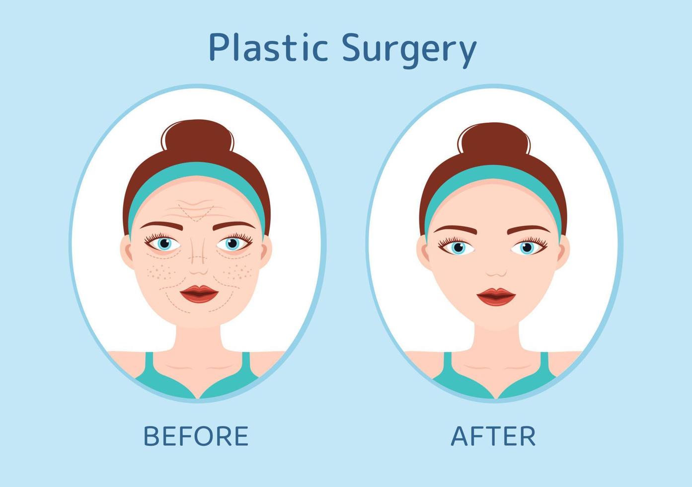 plastic chirurgie vlak tekenfilm hand- getrokken Sjablonen illustratie van medisch chirurgisch operatie Aan de lichaam of gezicht net zo verwacht gebruik makend van Geavanceerd uitrusting vector