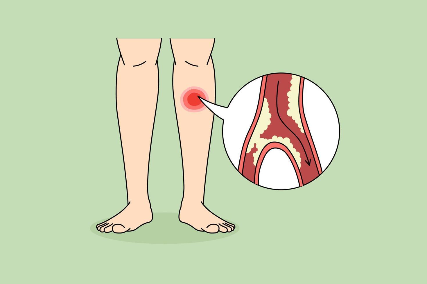 dichtbij omhoog van persoon lijden van stootkussen ziekte hebben bloed vaartuig verstopping in poten. Mens worstelen met geklonterd ledematen van aderen vernauwing of blokkeren. gezondheidszorg concept. vector illustratie.