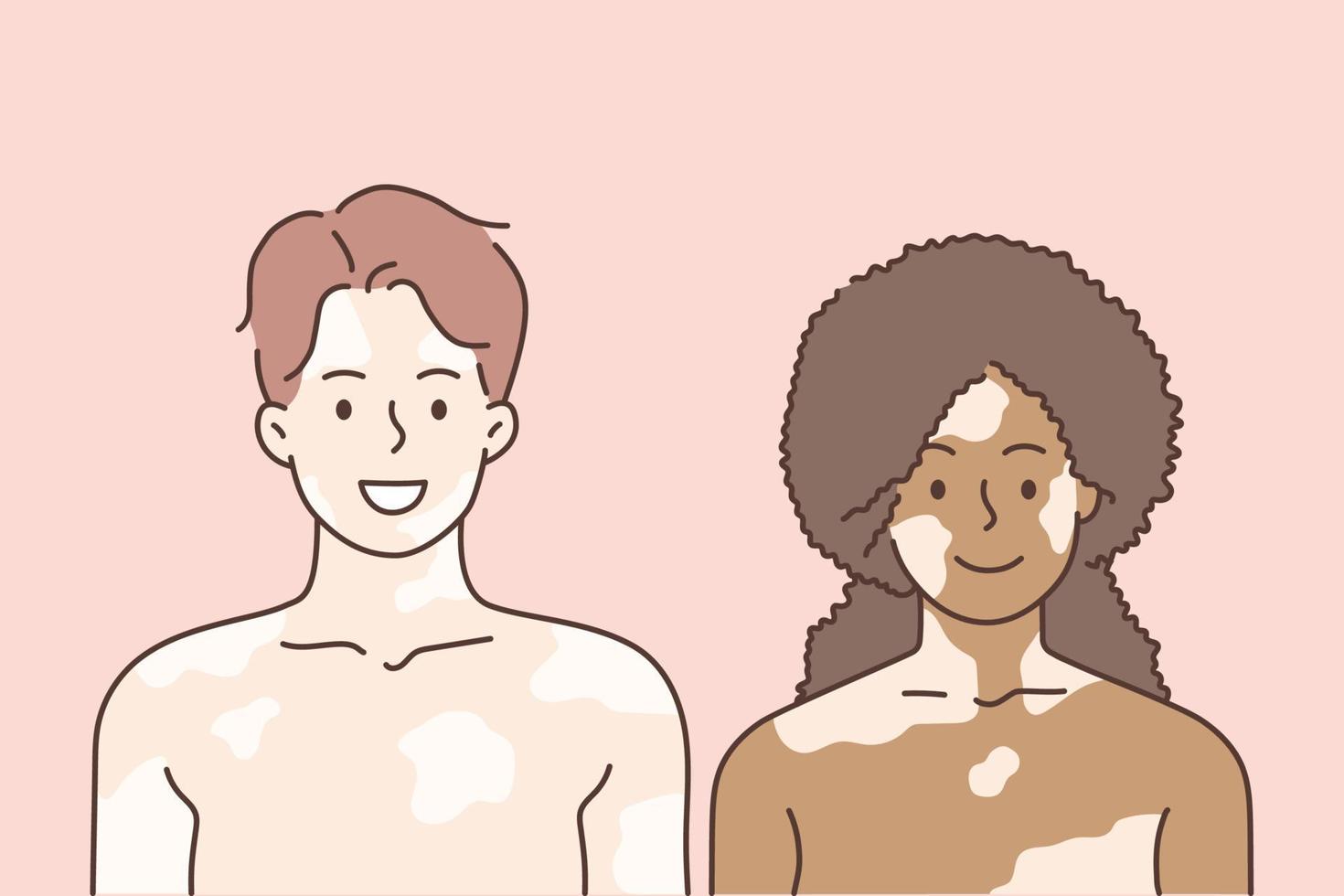 vitiligo en gemengd ras liefde concept. jong glimlachen vrouw en Mens paar staand samen hebben vitiligo Aan gezichten en lichamen gevoel liefde vector illustratie