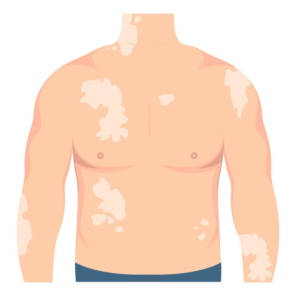 mannetje lichaam met vitiligo Aan de huid. schoonheid verscheidenheid concept, positief lichaam, zelfacceptatie, chronisch huid ziekte bewustzijn, illustratie vector