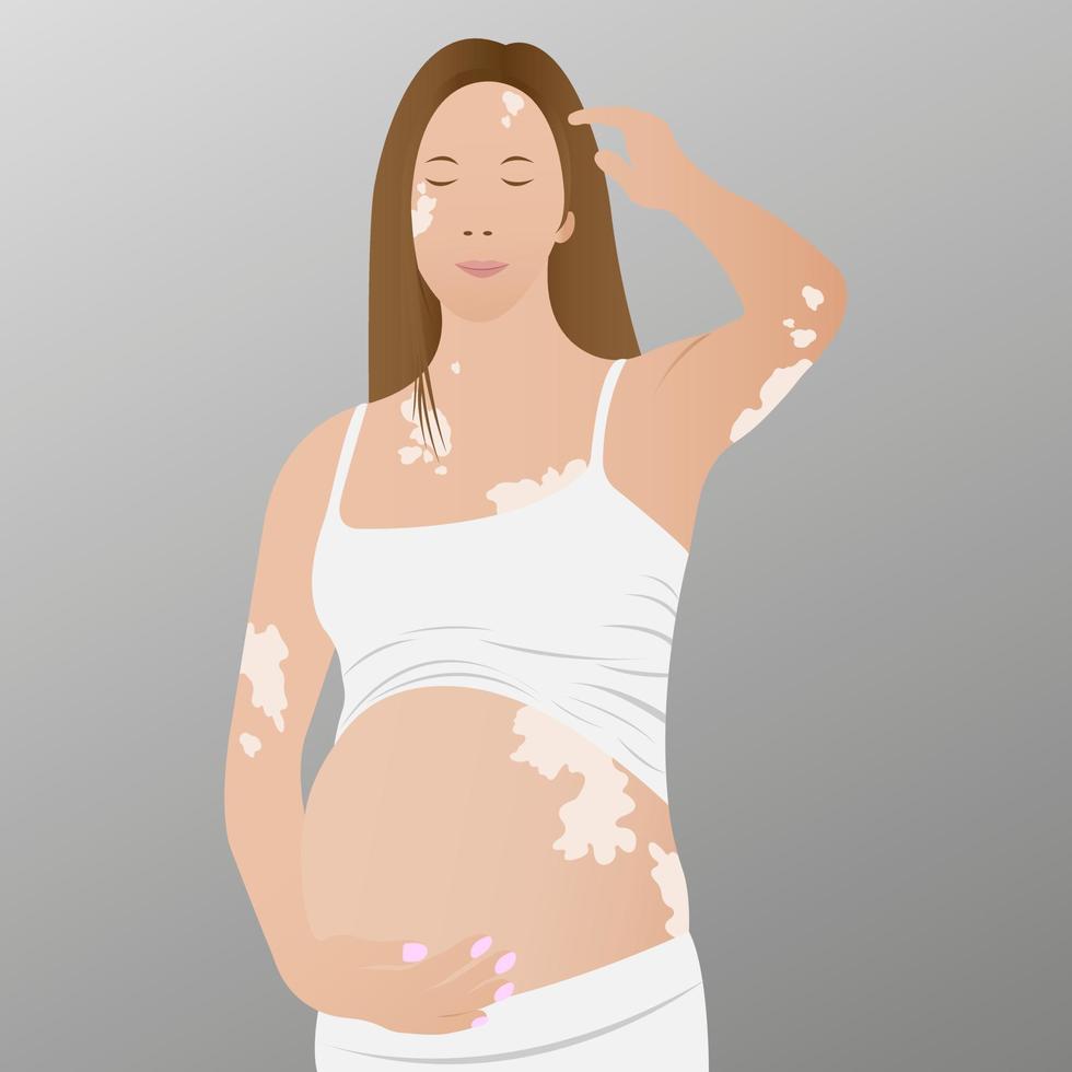 jong, zwanger vrouw met vitiligo Aan de huid. schoonheid verscheidenheid concept, positief lichaam, zelfacceptatie, bewustzijn van chronisch huid ziekten, illustratie vector