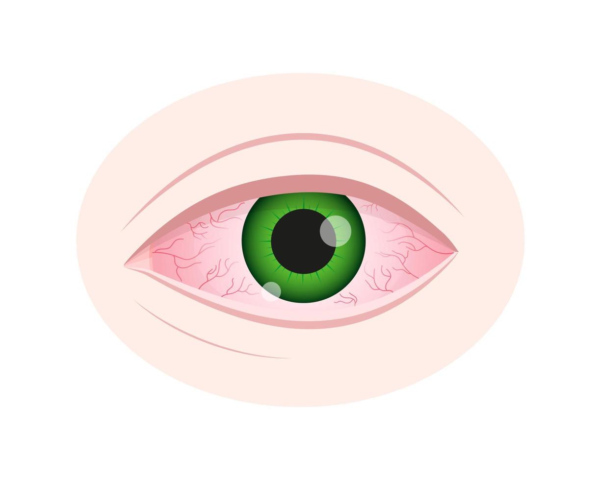 oog irritatie. ontstoken bloeddoorlopen oogbol met rood bindvlies geïsoleerd Aan wit achtergrond. symptoom van keratitis, allergie, conjunctivitis, uveïtis vector