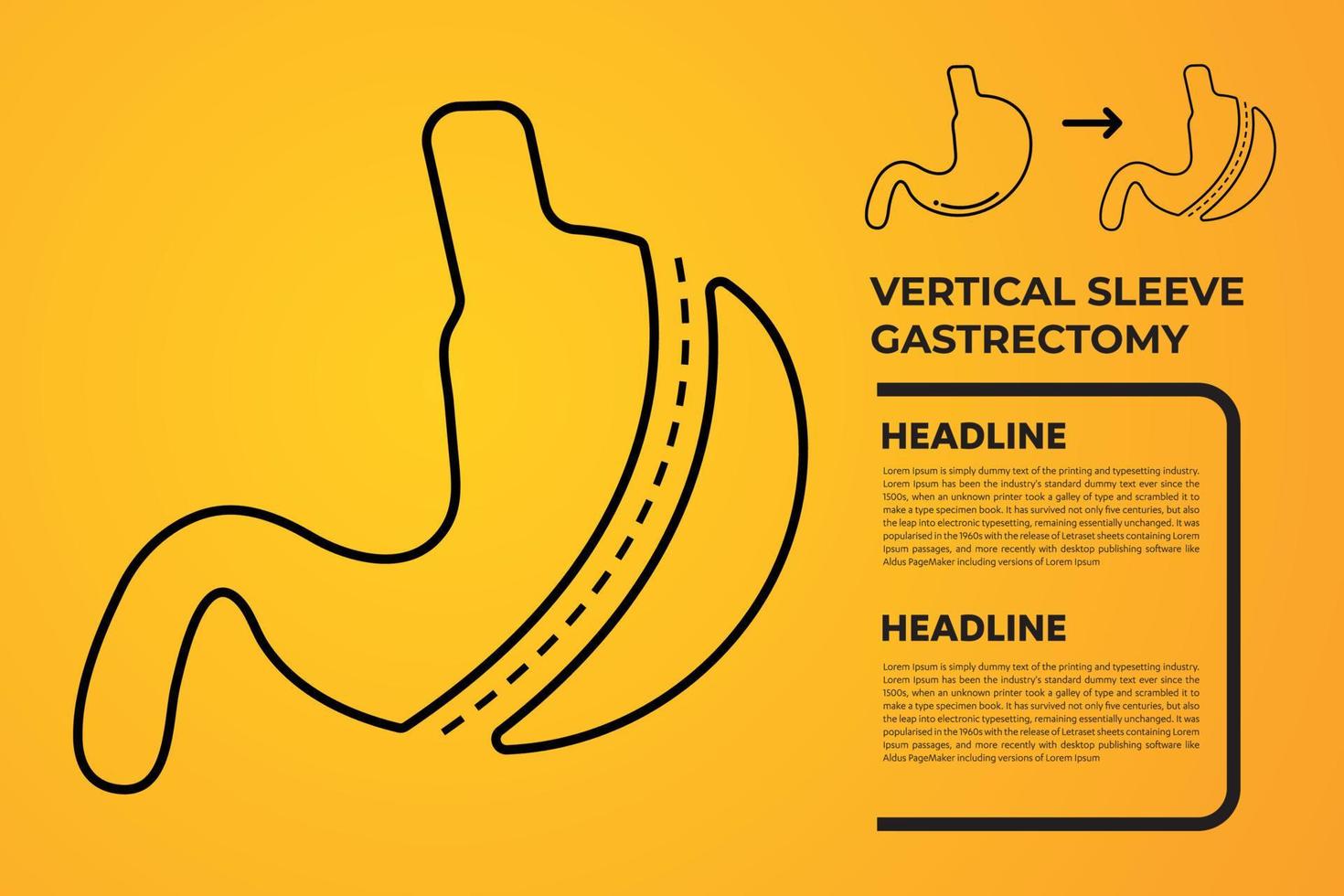 laparoscopisch mouw gastrectomie, verticaal gastrectomie, gewicht verlies chirurgie vector illustratie van maag vermindering chirurgie