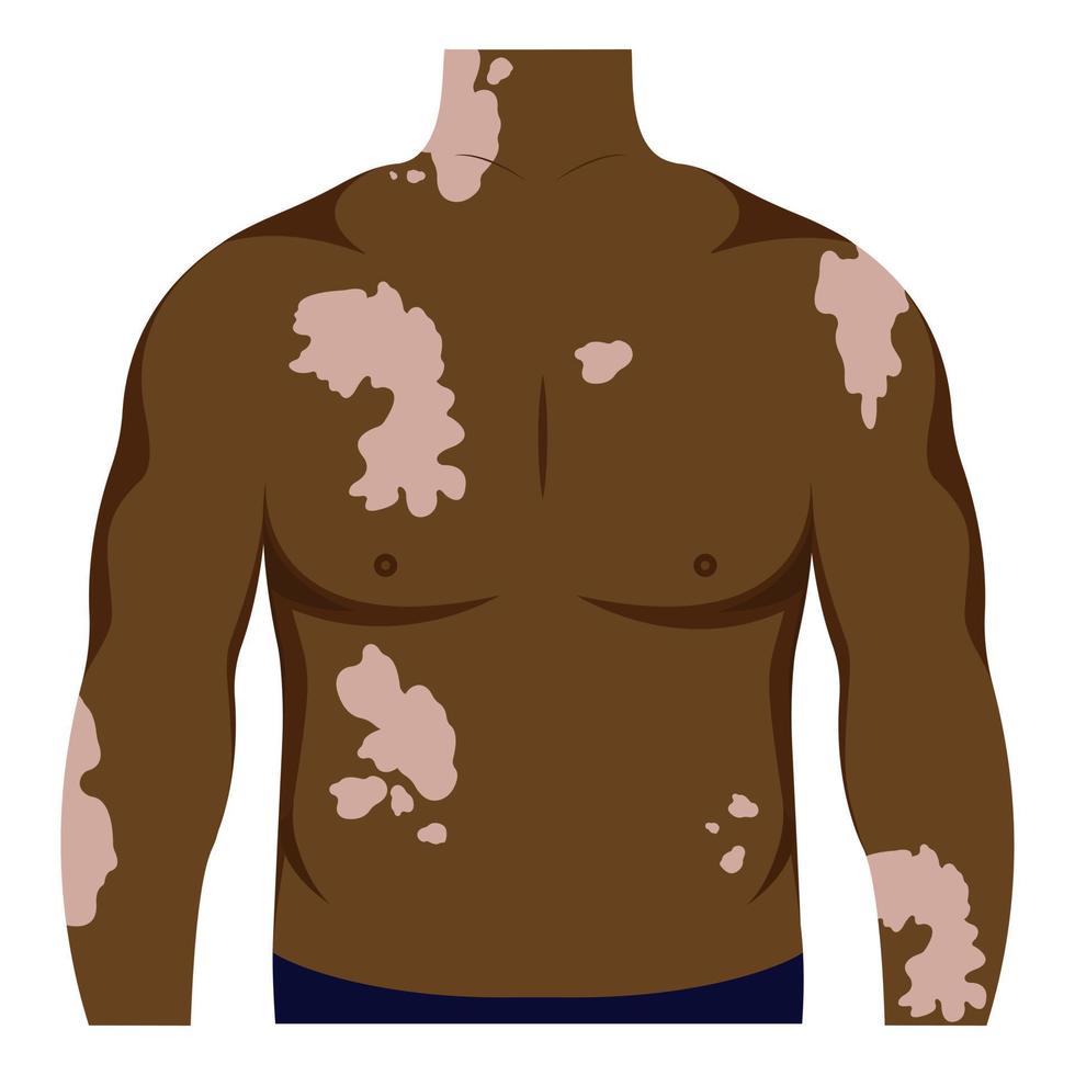 Afrikaanse Amerikaans met vitiligo Aan de huid. schoonheid verscheidenheid concept, positief lichaam, zelfacceptatie, chronisch huid ziekte bewustzijn, illustratie vector