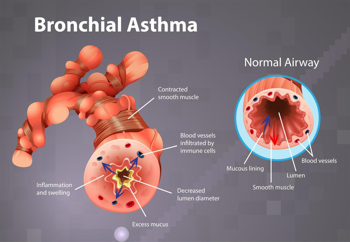 astma ontstoken bronchiale buis poster vector