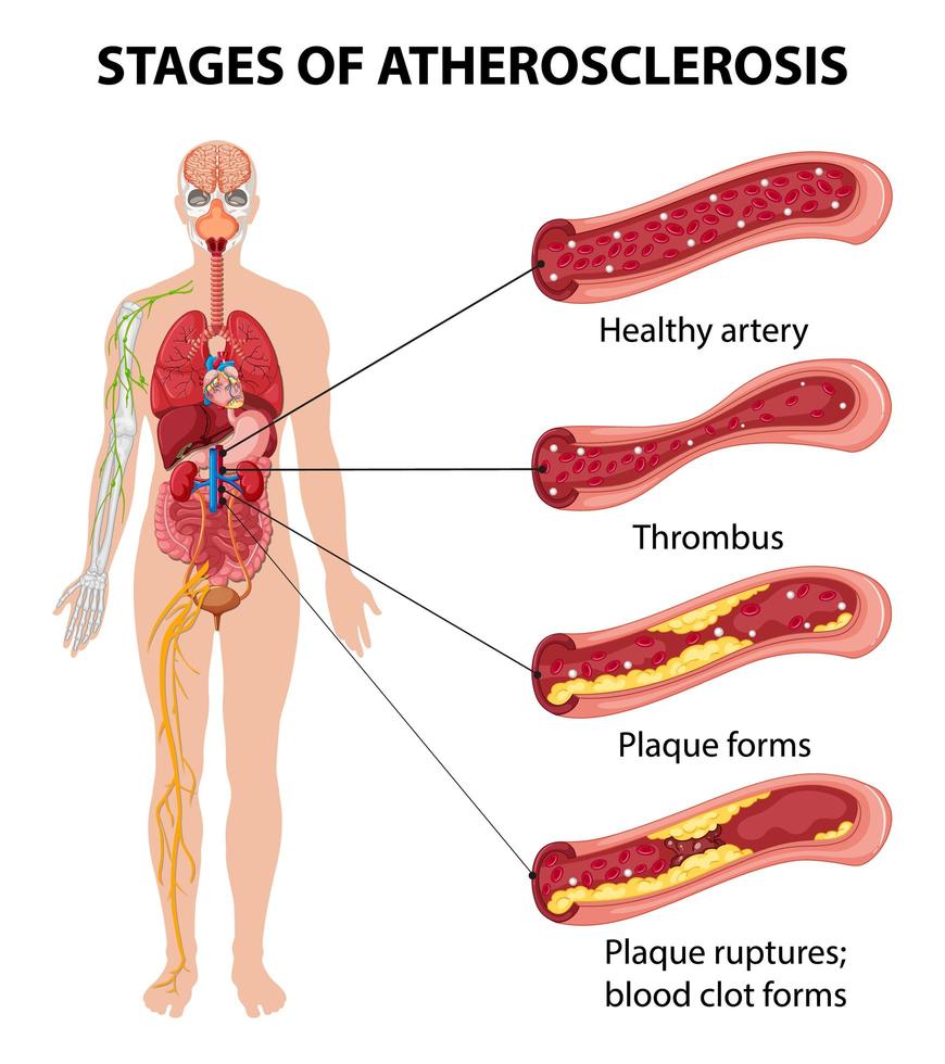 stadia van atherosclerose informatie infographic vector