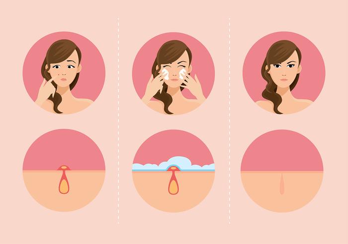 Meisjes En Pimples Gratis Vector