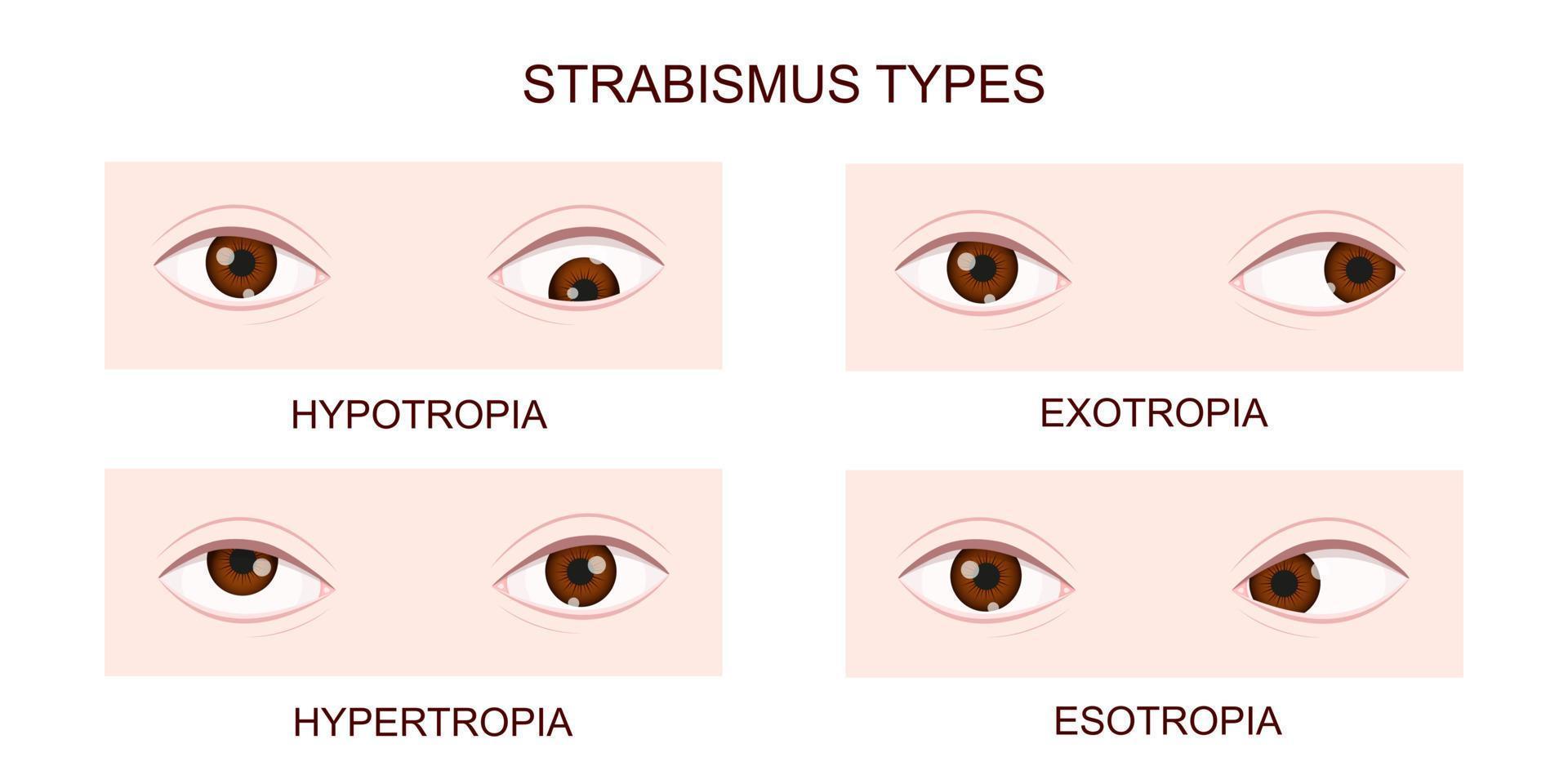 scheelzien soorten. hypotropie, hypertropie, exotropie, esotropie. menselijk ogen met verschillend scheel aandoeningen. gekruiste ogen staat vector