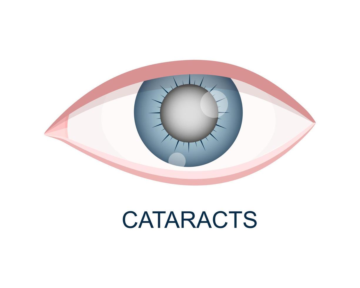 cataract oog dichtbij omhoog visie. oogbol met bewolkt lens. anatomisch accuraat menselijk orgaan van visie met veroudering problemen vector