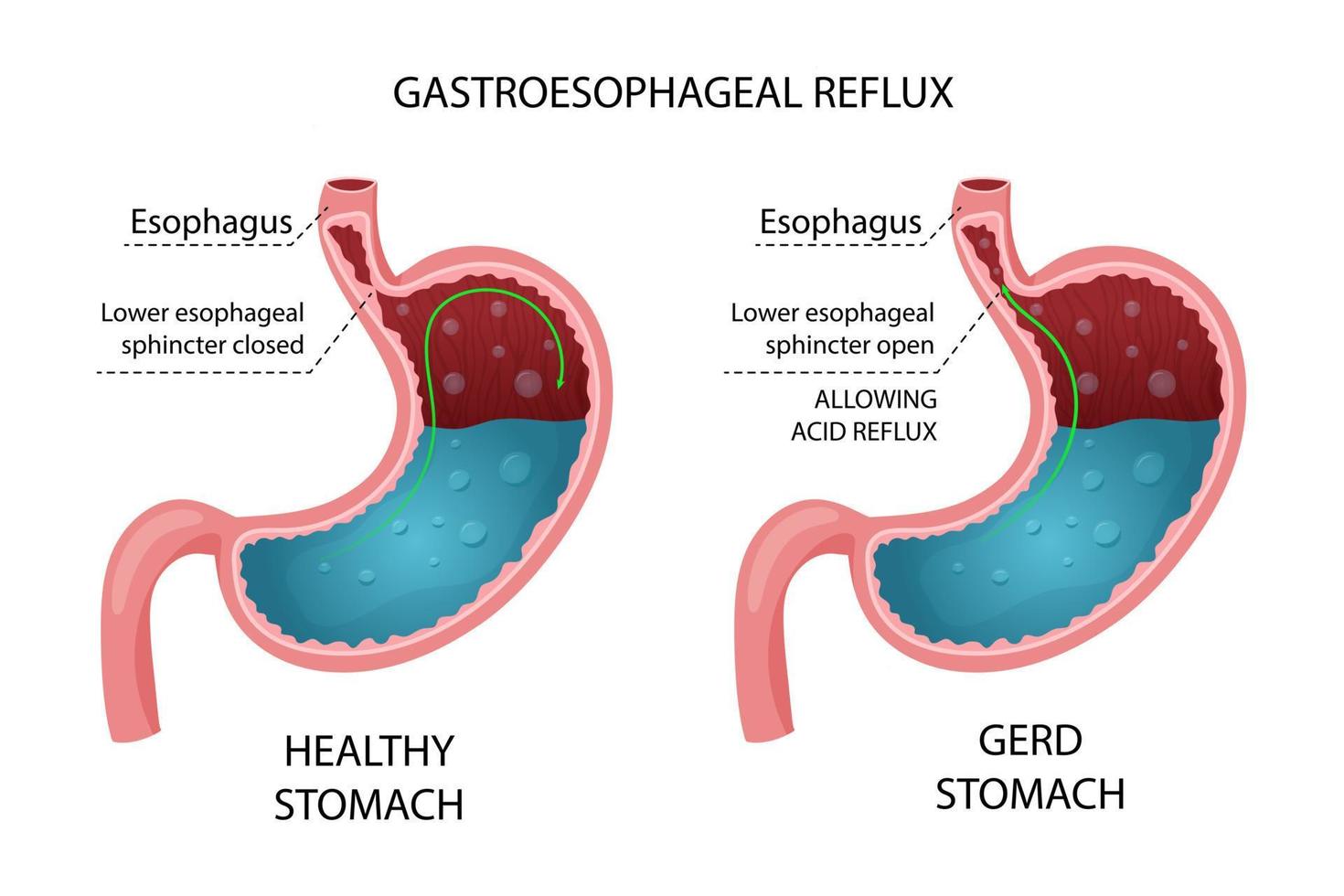 gezond maag en gerd infographic vector