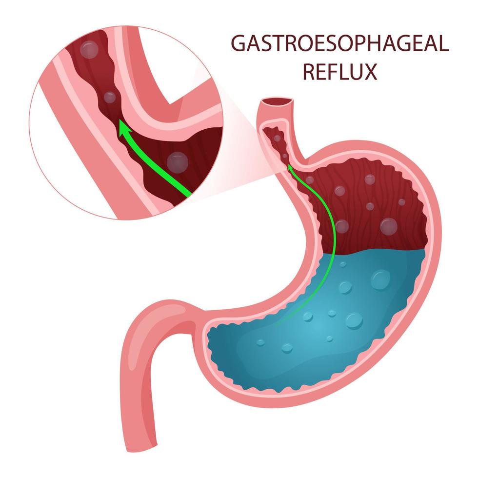 gastro-oesofageale reflux ziekte diagram vector