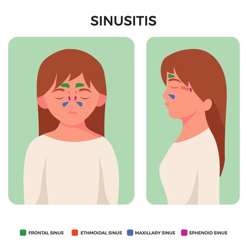 Sinusitis Ziekte Sinus Anatomie Illustratie vector