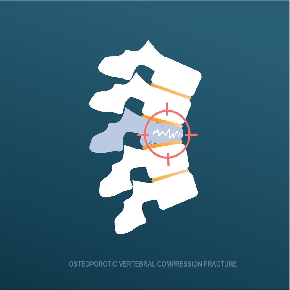 osteoporotisch wervel compressie breuk vector