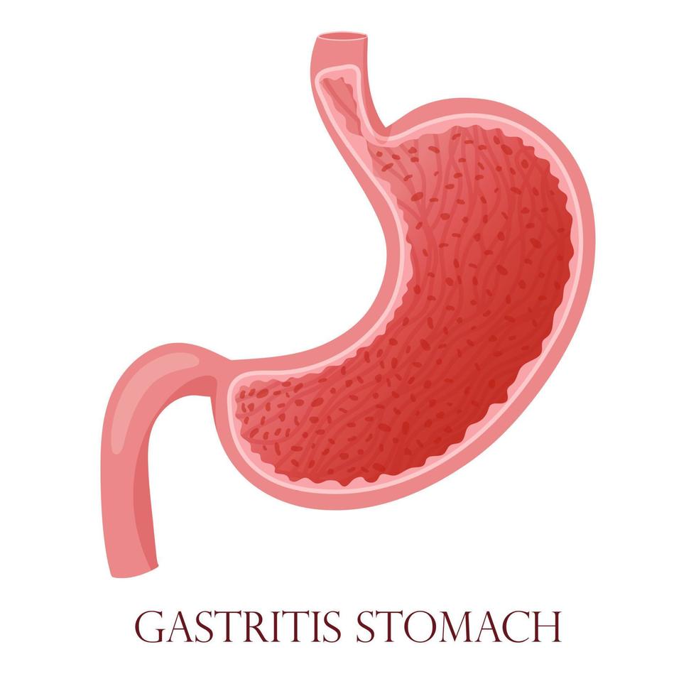 gastritis slijmvlies cellen ontsteking illustratie vector