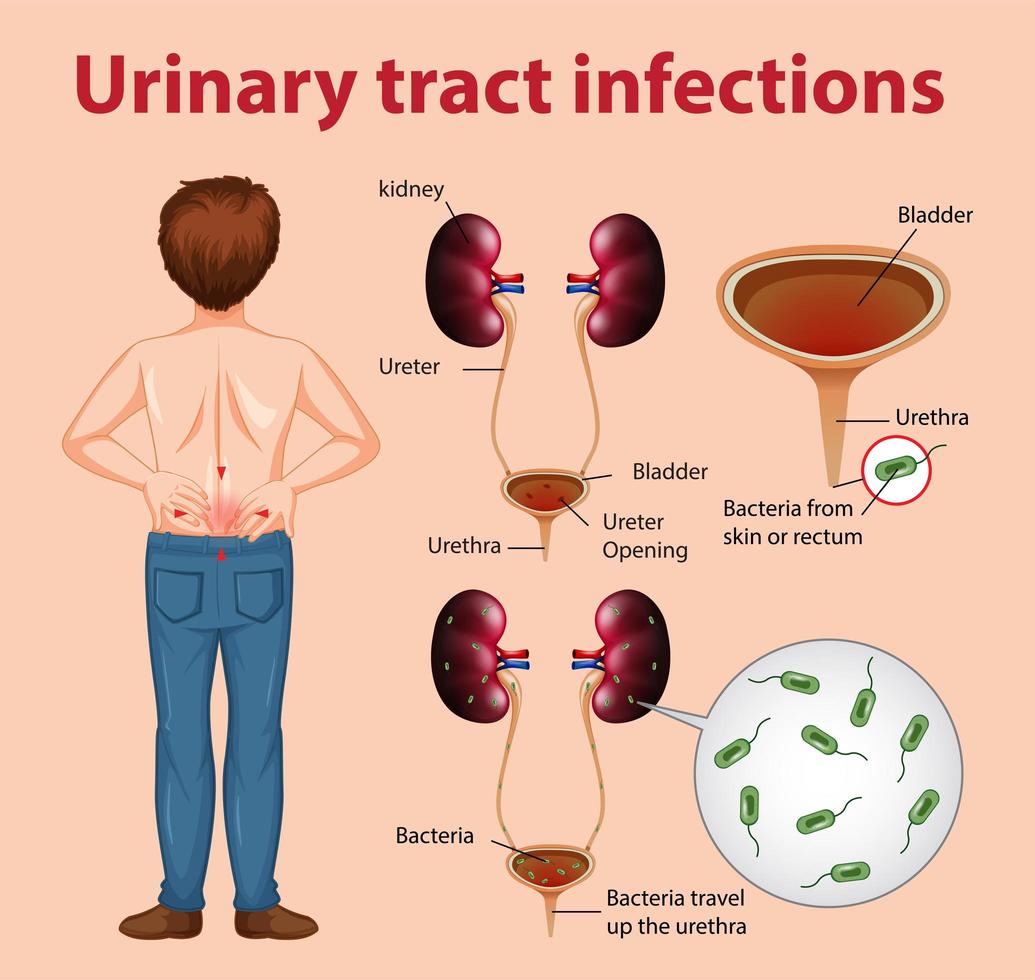 informatieve illustratie van urineweginfecties vector