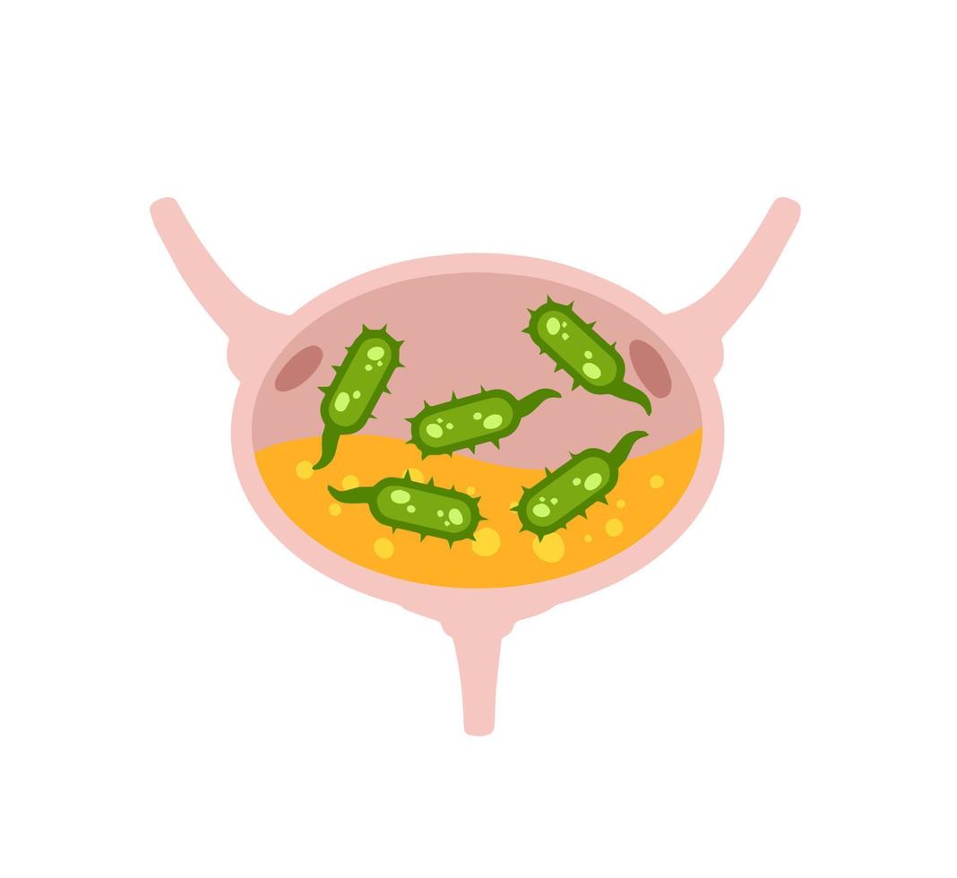 virus in de blaas. infectie en ontsteking van urine en intern orgaan. medisch probleem en illustratie. groen virus en bacteriën. vector