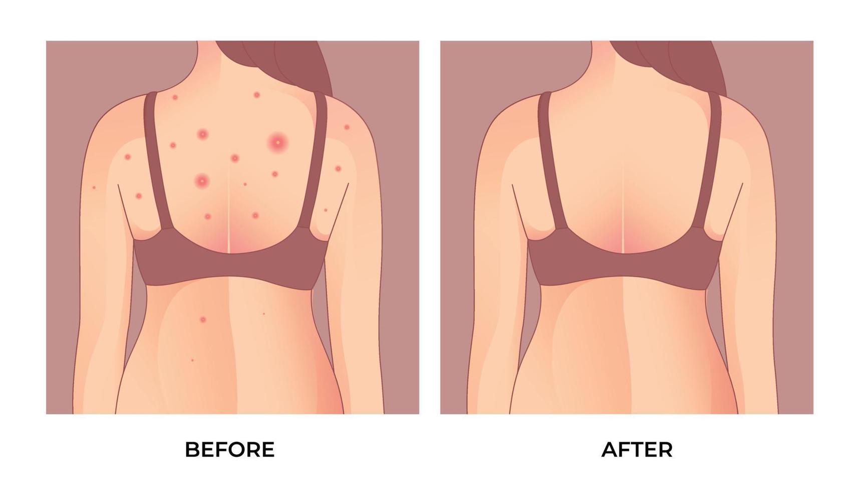 meisje met acne, met rood vlekken Aan de rug, folliculitis opruiend, acne behandeling voordat en na. huid zorg concept. vector