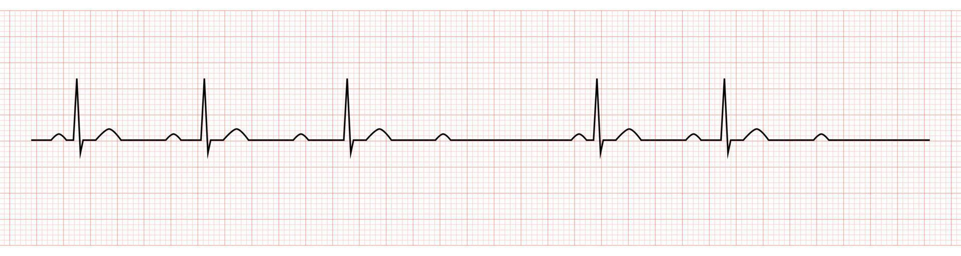 ekg tonen tweede mate av blok mobitz ik vector