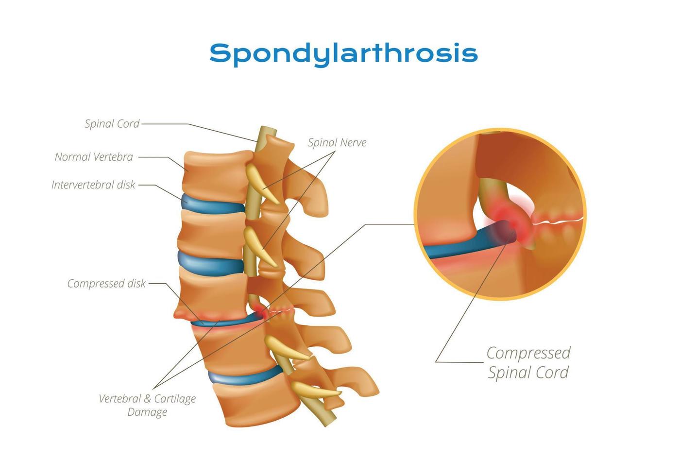 spondylartrose spinal koord infographics vector