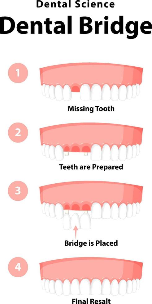 infographic van mens in tandheelkundige brug op witte achtergrond vector