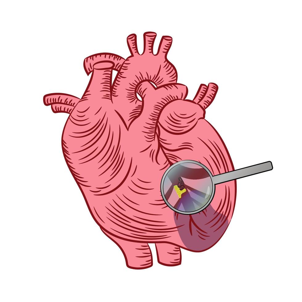 hartspier infarct hart ziekte geneeskunde onderwijs regeling vector