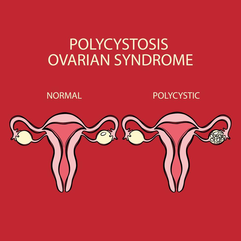 polycystisch eierstok syndroom vs normaal voortplantings- systeem vector