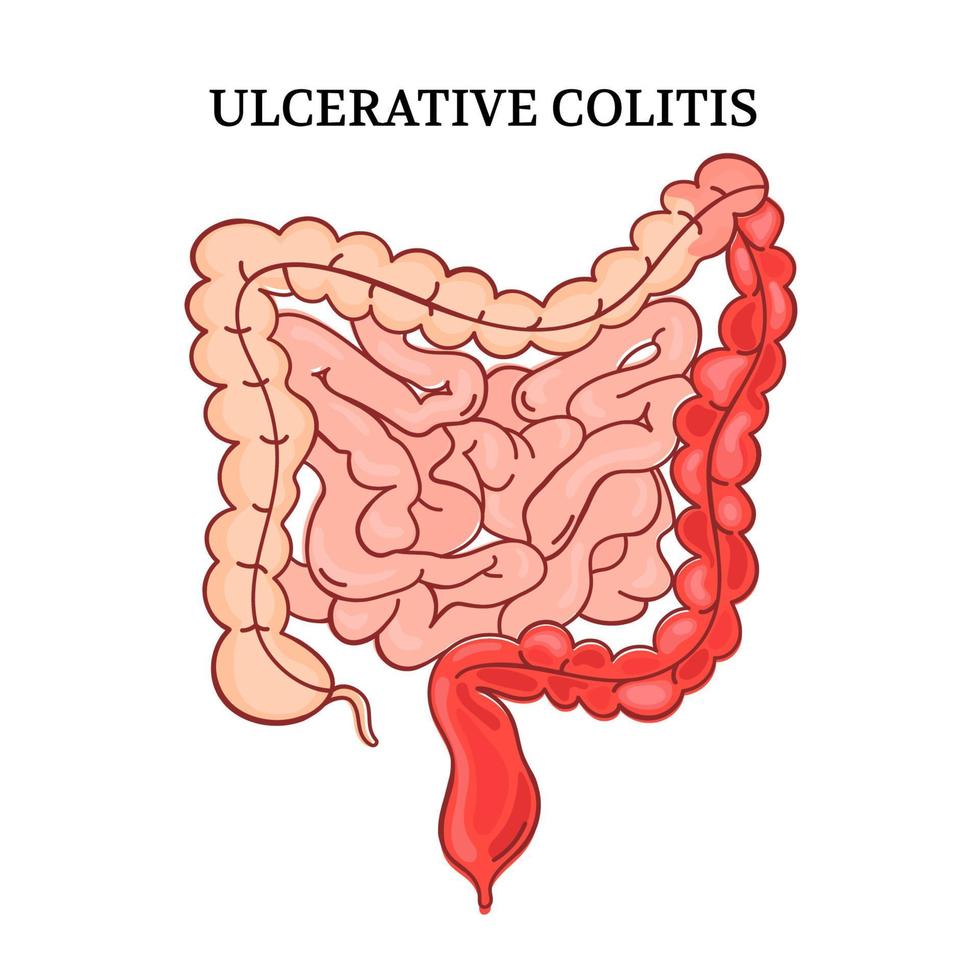 ulceratief colitis darmen geneeskunde anatomie vector regeling